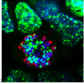 Célula tumoral tratada con los inhibidores de ATR desarrollados en el CNIO. En verde, las roturas en el ADN de las células generadas por el tratamiento. En azul, los cromosomas. /CNIO 