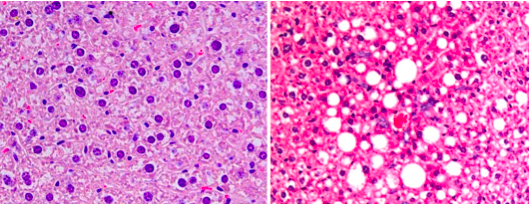 A la izquierda, imagen históloga de un hígado sano. A la derecha, un hígado con NASH. Fotos cedidas por el CNIO.