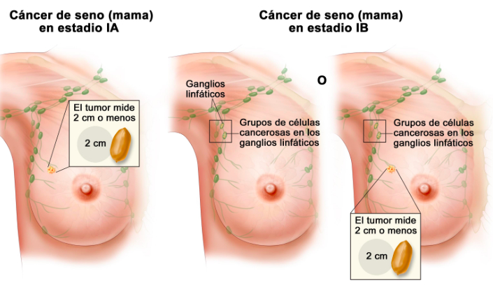diferentes estadios del cáncer de mama