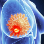 Necesidades y retos en la atención al cáncer de mama metastásico